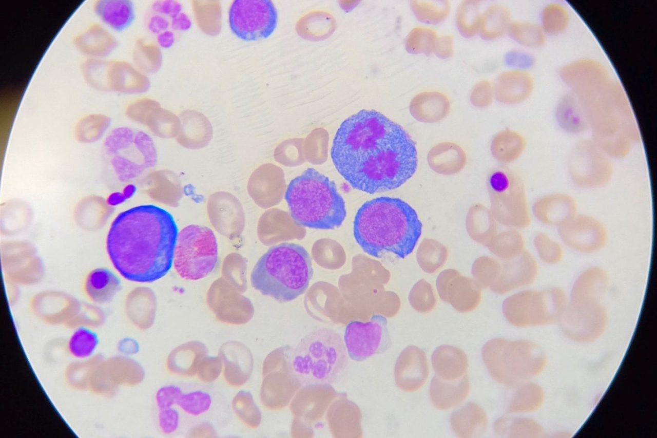 Mitoses in Bone Marrow in B12-Deficiency Anemia
