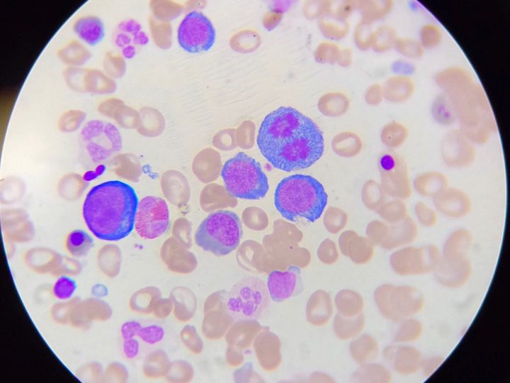 Bone marrow smear, megaloblasts and a dividing cell in the field of view