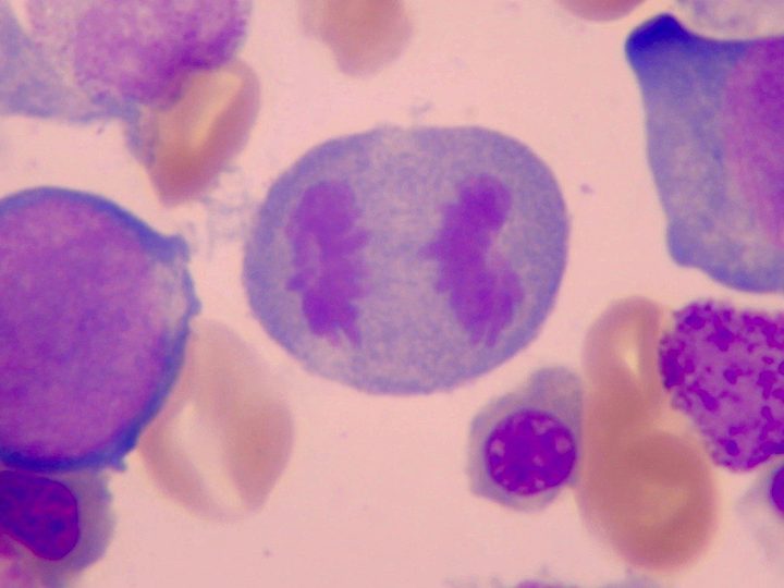 Bone marrow smear, anaphase of mitosis in an erythroid precursor