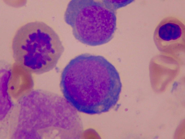 Bone marrow smear, metaphase plate next to a megaloblast