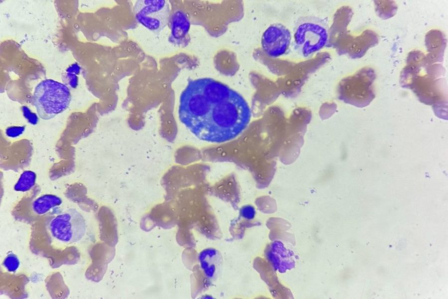 Multinucleated Plasma Cells in Bone Marrow
