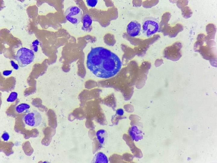 Bone marrow smear: trinucleated plasma cell in the center of the field of view