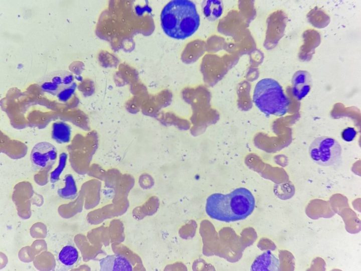Bone marrow smear: binucleated plasmacyte with basophilic cytoplasm