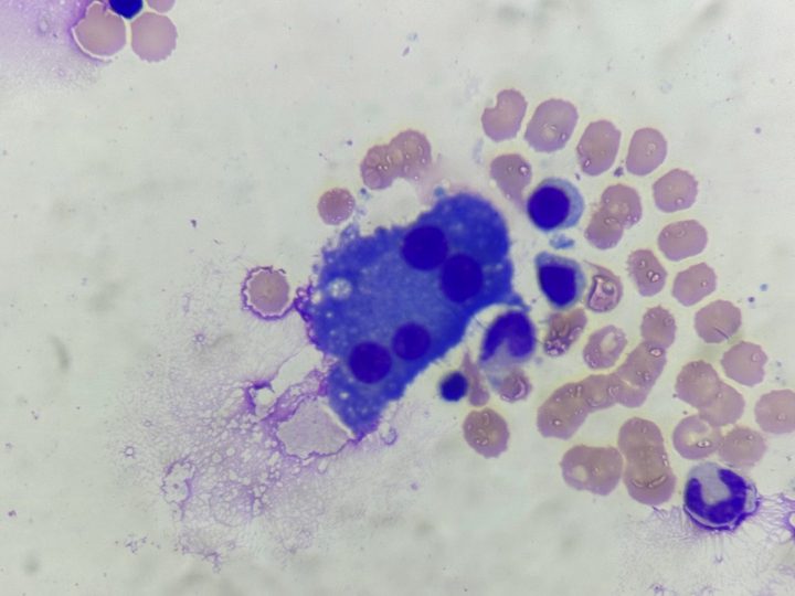 Bone marrow smear: large multinucleated plasma cell with four nuclei