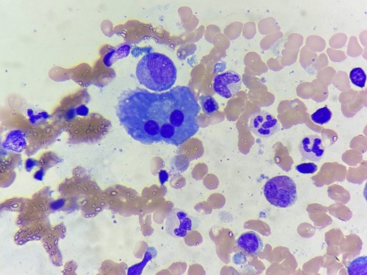 Bone marrow smear: trinucleated plasmacyte with eccentrically located nuclei