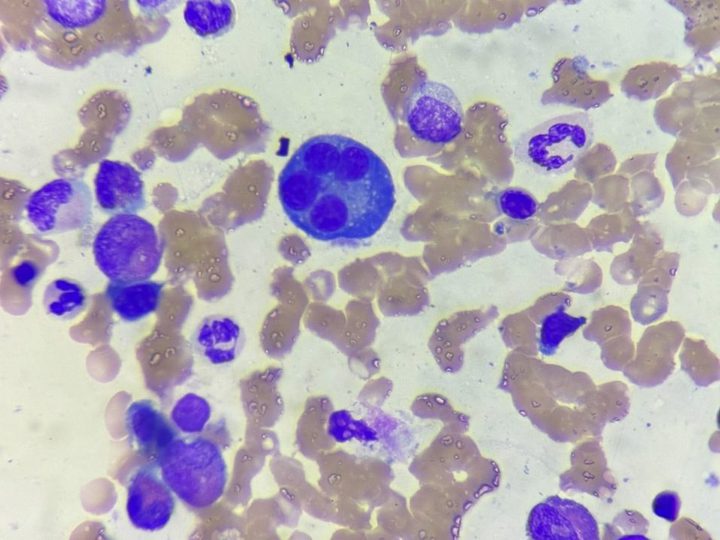 Bone marrow smear: plasma cell with four nuclei in sternal aspirate