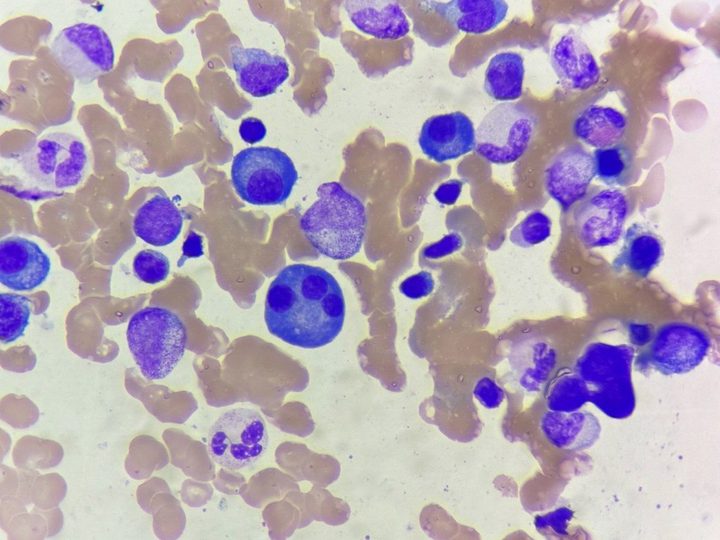 Bone marrow smear: multinucleated plasmacyte among granulocytic series elements