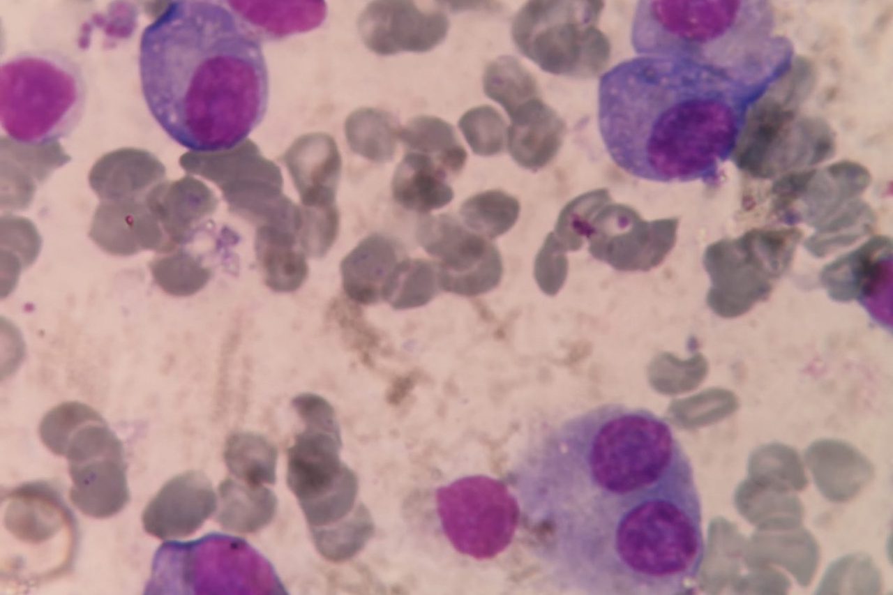 Multiple Myeloma: Atypical Plasma Cells in Bone Marrow