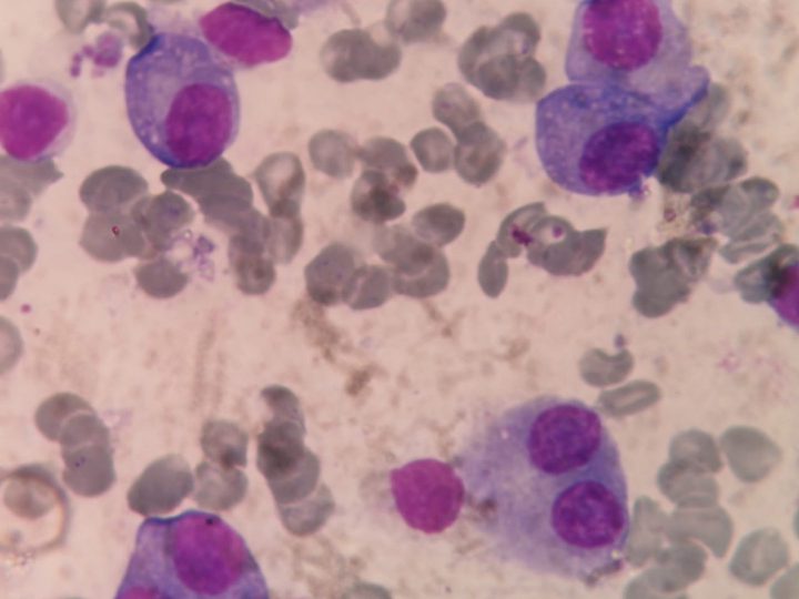 Bone marrow smear: binucleated and mature plasma cells
