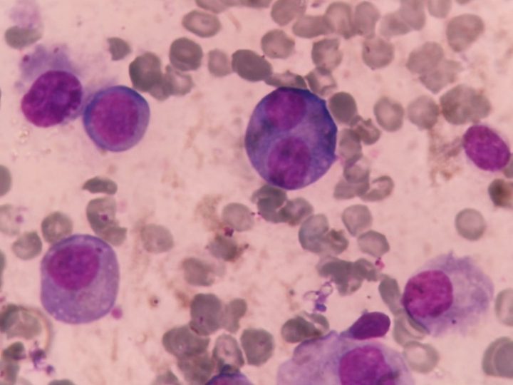Bone marrow smear: binucleated plasmacyte with basophilic cytoplasm
