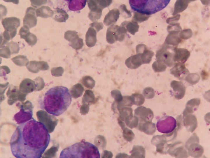 Bone marrow smear: atypical plasma cells with a perinuclear clear zone