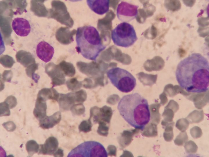 Bone marrow smear: plasma cells with varying degrees of maturity