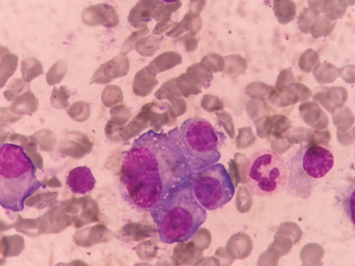 Bone marrow smear: dense cluster of atypical plasma cells