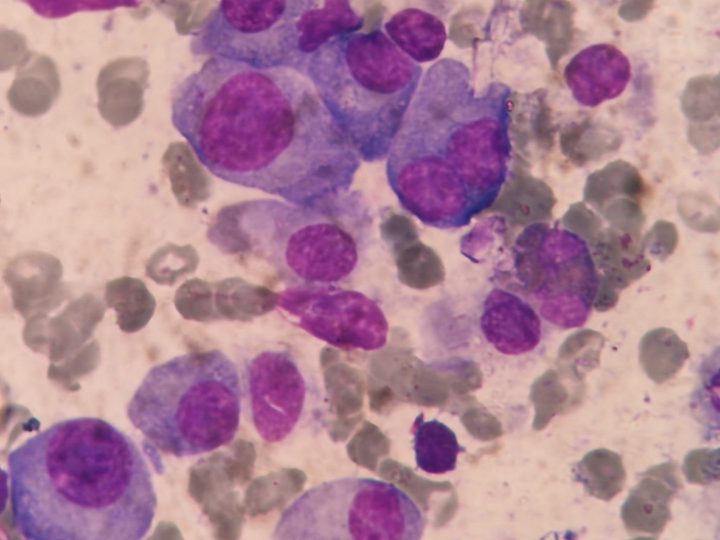 Bone marrow smear: polymorphic plasma cells and a binucleated form