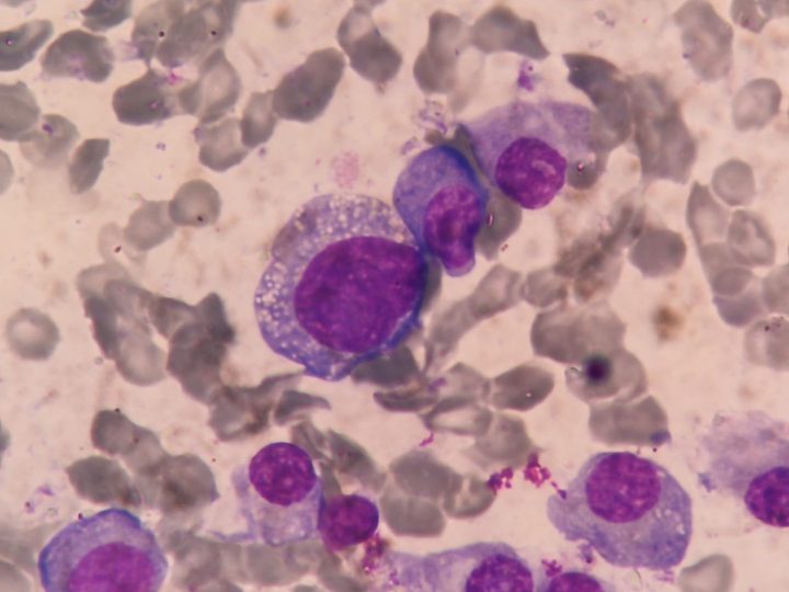 Bone marrow smear: large plasmacyte with pronounced cytoplasmic vacuolization