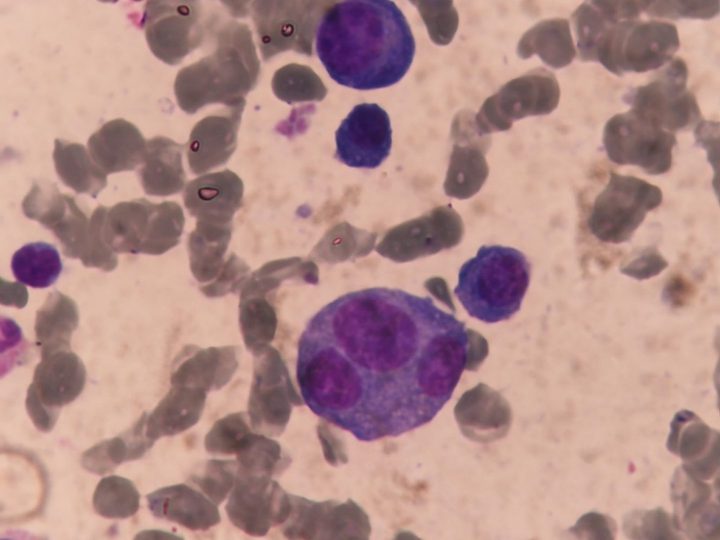 Bone marrow smear: trinucleated plasma cell in the aspirate