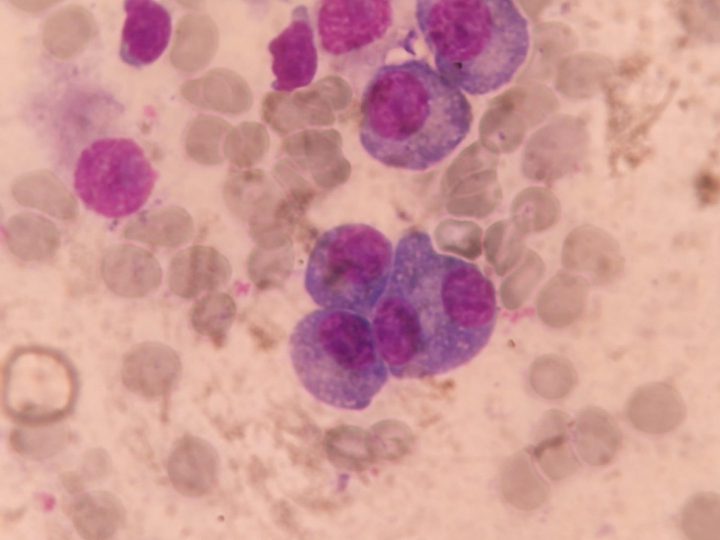 Bone marrow smear: group of plasma cells with eccentric nuclei