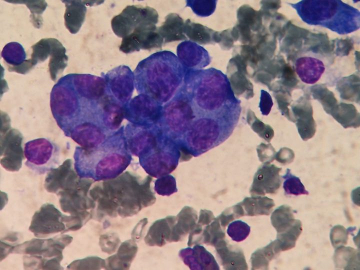Bone marrow smear: large cluster of anaplastic plasma cells