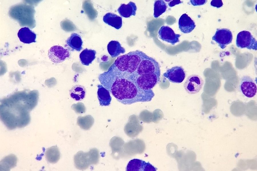 Multiple Myeloma: Bone Marrow Cell Morphology