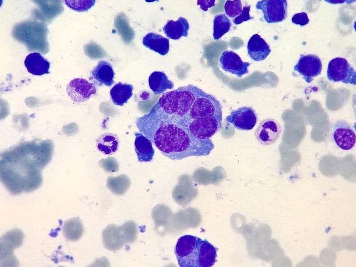 Bone marrow smear: giant multinucleated plasma cell and plasmacytes