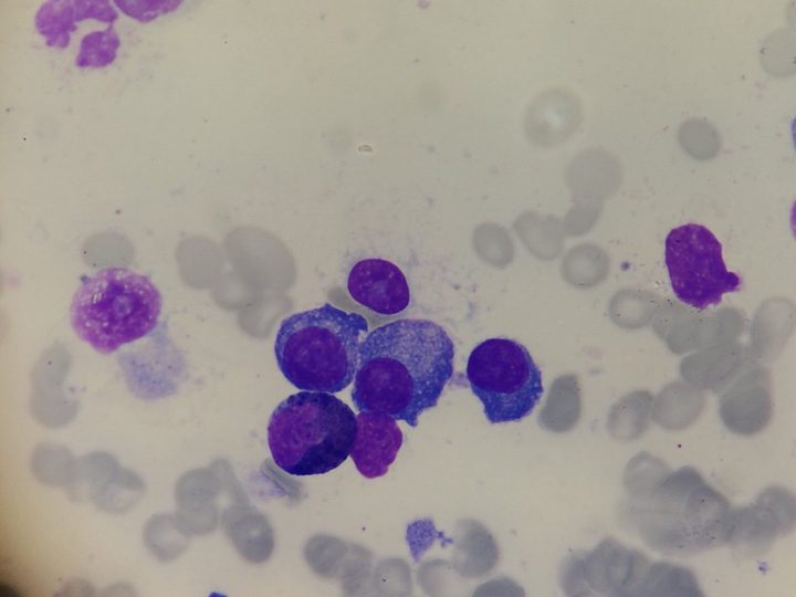 Bone marrow smear: cluster of atypical plasma cells and proplasmacytes