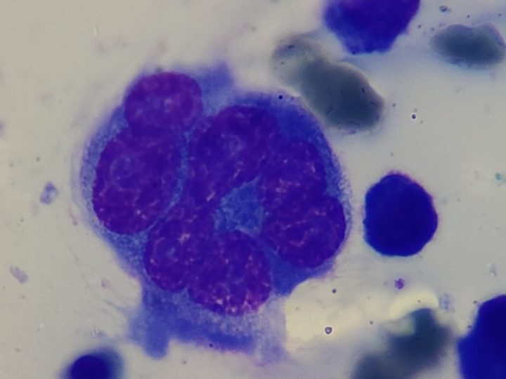 Bone marrow smear: large multinucleated plasma cell at high magnification