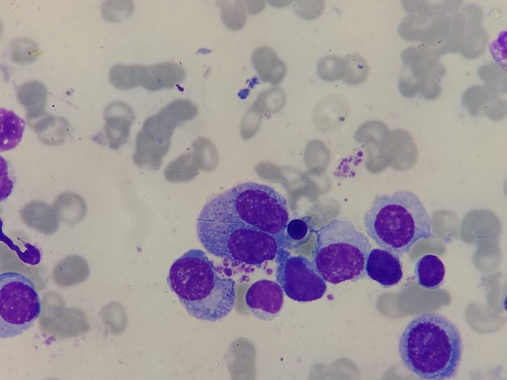 Bone marrow smear: plasma cells and a binucleated plasmacyte