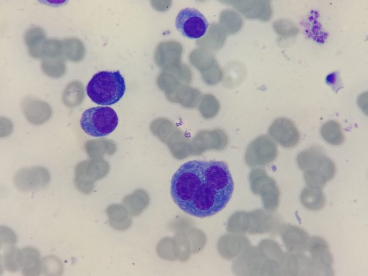 Bone marrow smear: trinucleated plasma cell and mononuclear forms