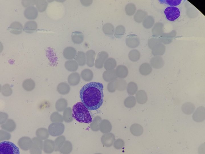 Bone marrow smear: plasmacytes with basophilic cytoplasm and eccentric nucleus