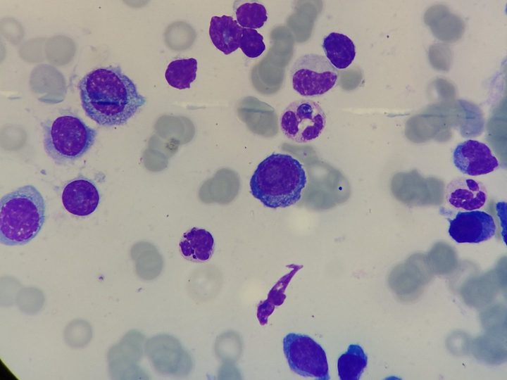 Bone marrow smear: diffuse infiltration by atypical plasma cells