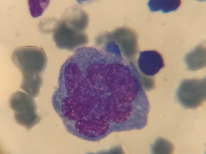Bone marrow smear: multinucleated polyploid plasmacyte with basophilic cytoplasm