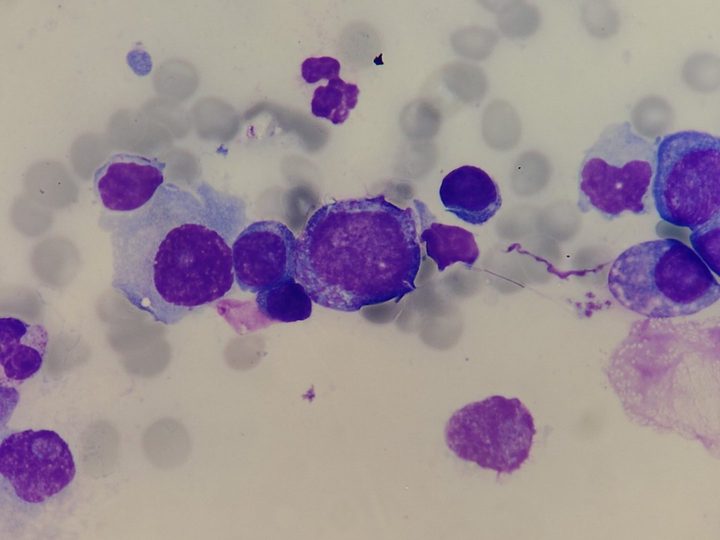 Bone marrow smear: large proplasmacyte and mature plasma cells