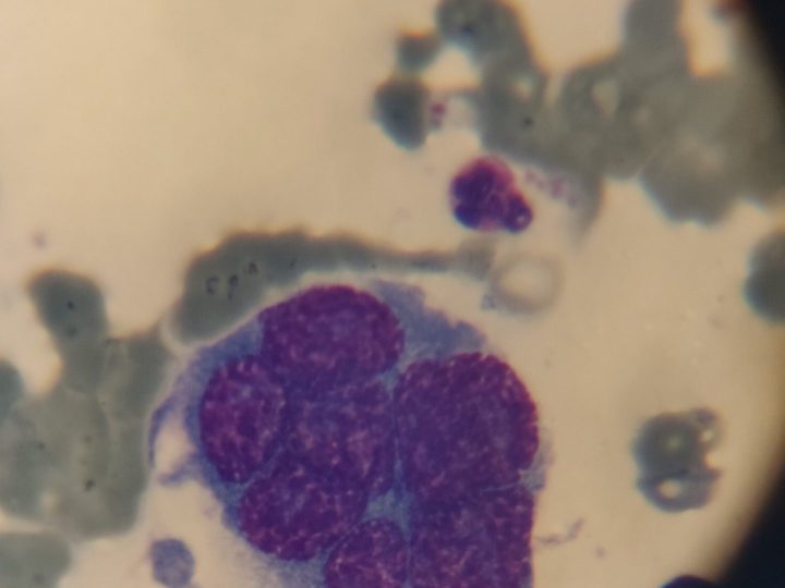 Bone marrow smear: atypical multinucleated plasma cell in the field of view