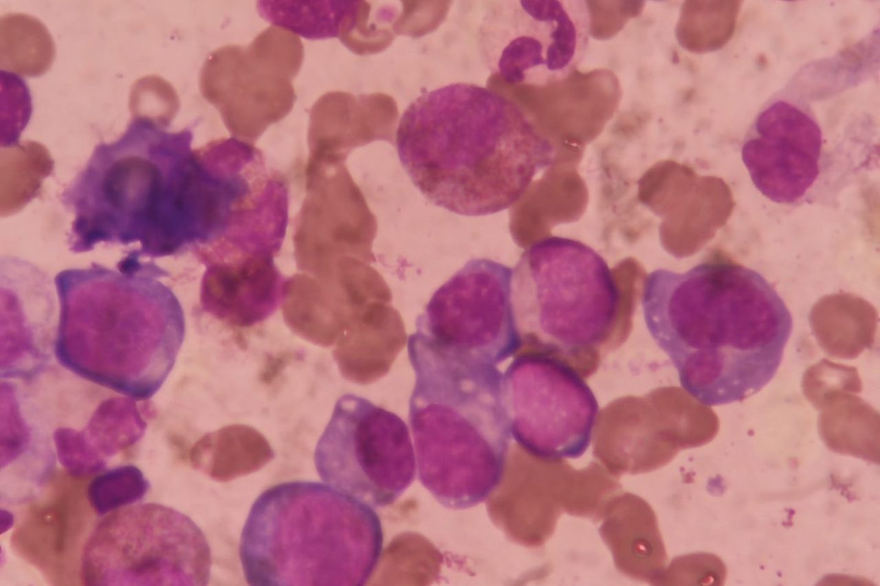 Multiple Myeloma: Plasma Cells in Myelogram