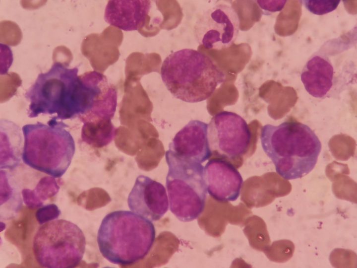 Bone marrow smear: plasma cells among myeloid elements