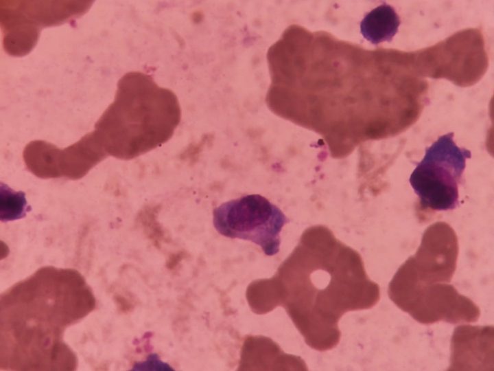 Bone marrow smear: plasmocytes and pronounced rouleaux formation of erythrocytes