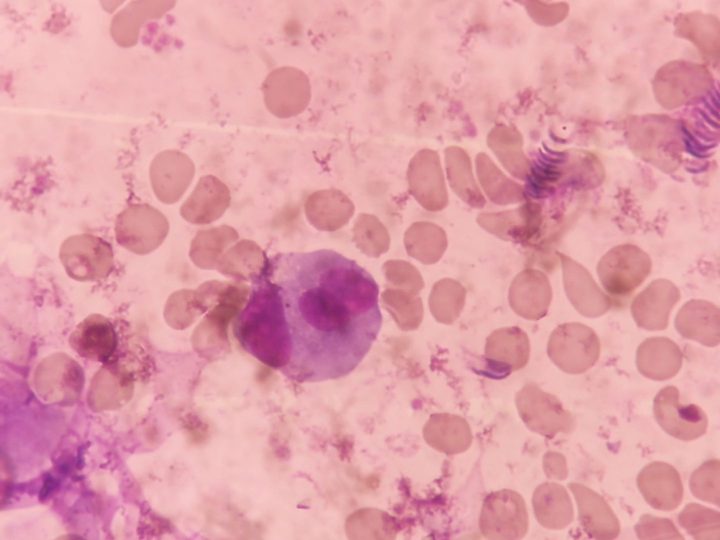 Bone marrow smear: binucleated plasmocyte and erythrocyte aggregation