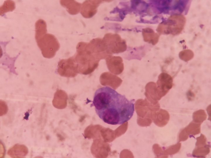 Bone marrow smear: binucleated plasma cell with basophilic cytoplasm