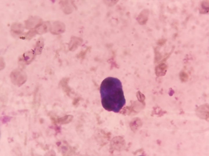 Bone marrow smear: plasmocyte with eccentrically located nucleus