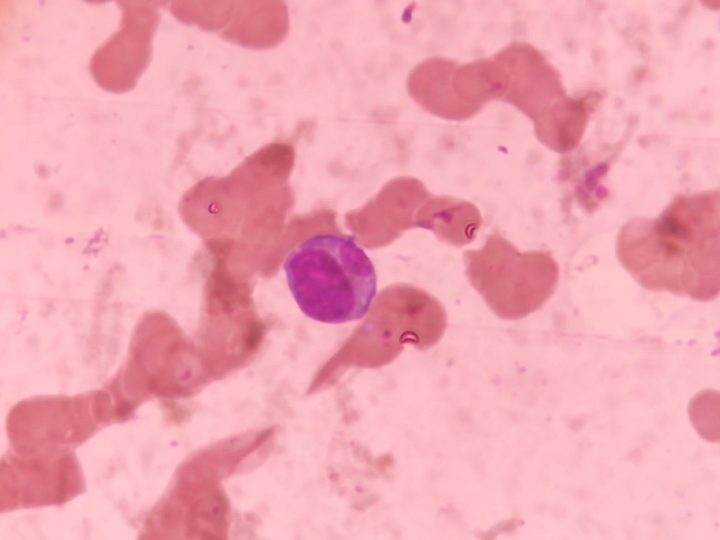 Bone marrow smear: plasma cell against the background of rouleaux formation
