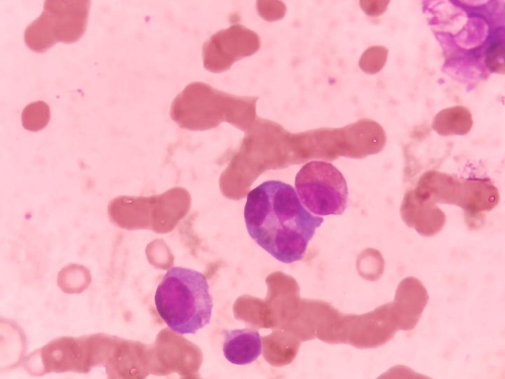 Bone marrow smear: group of plasmocytes and erythrocyte agglutination