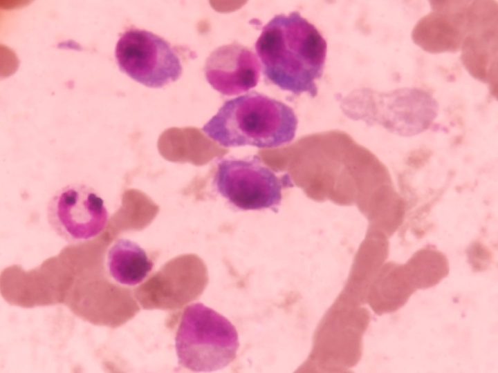 Bone marrow smear: plasma cells, including a binucleated form