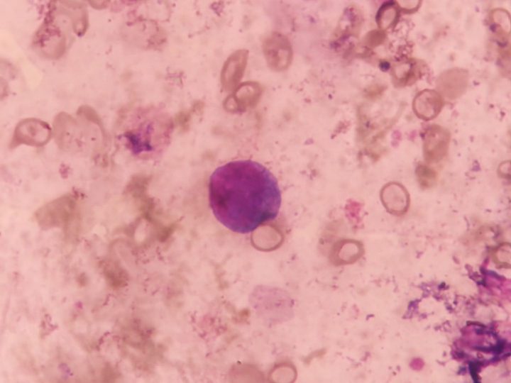 Bone marrow smear: isolated atypical plasmocyte in the field of view
