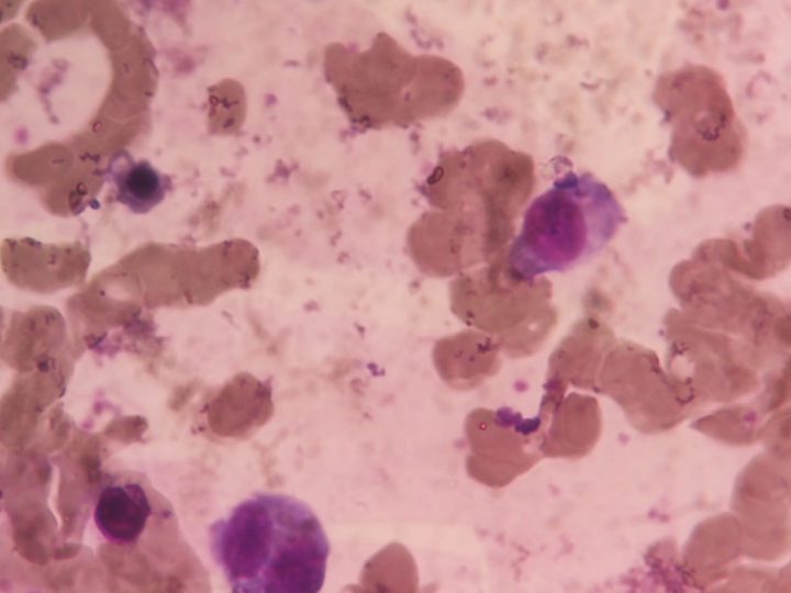Bone marrow smear: plasmocytes against the background of erythrocyte aggregates