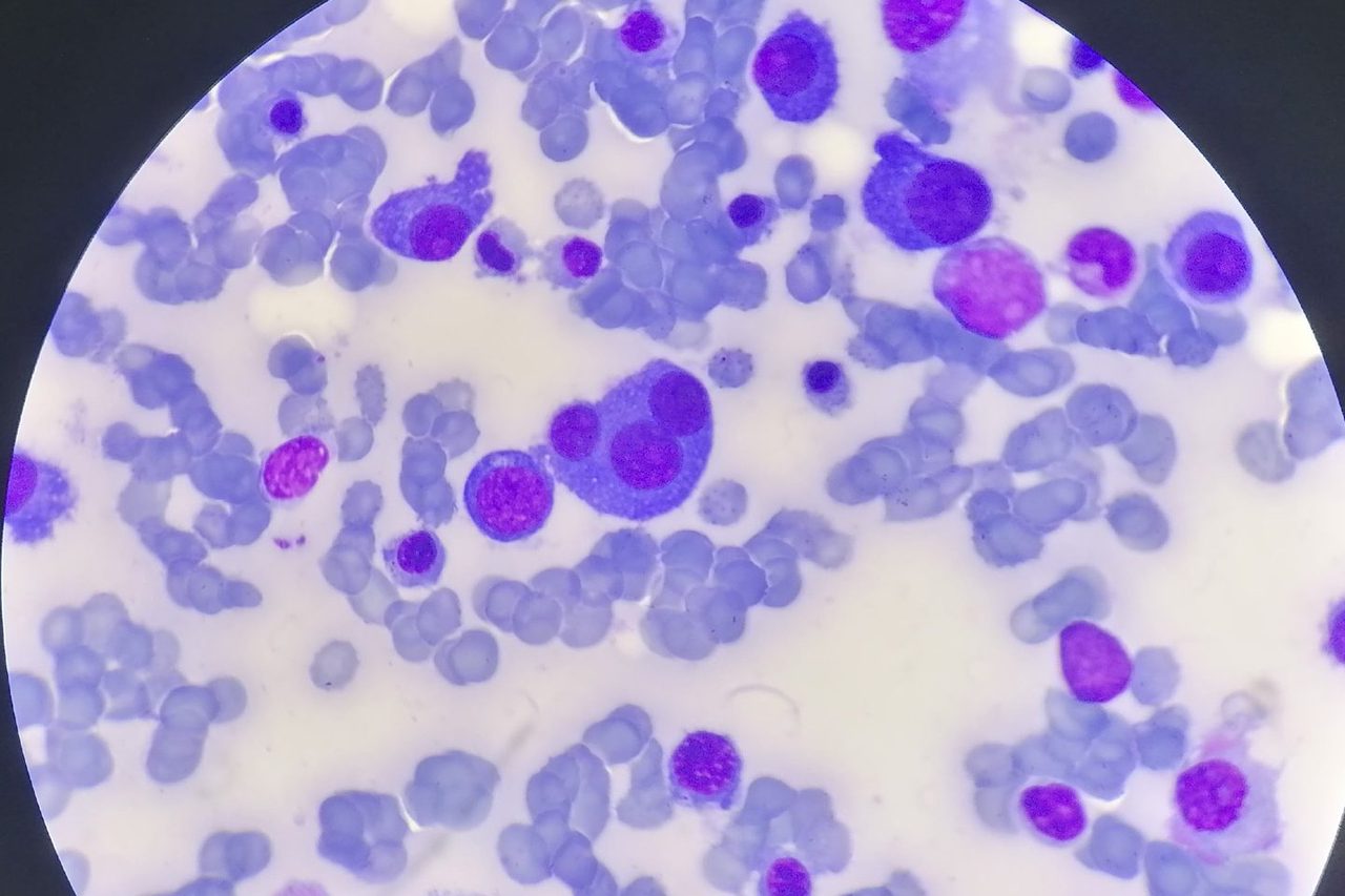 Multiple Myeloma: Plasma Cells in Bone Marrow