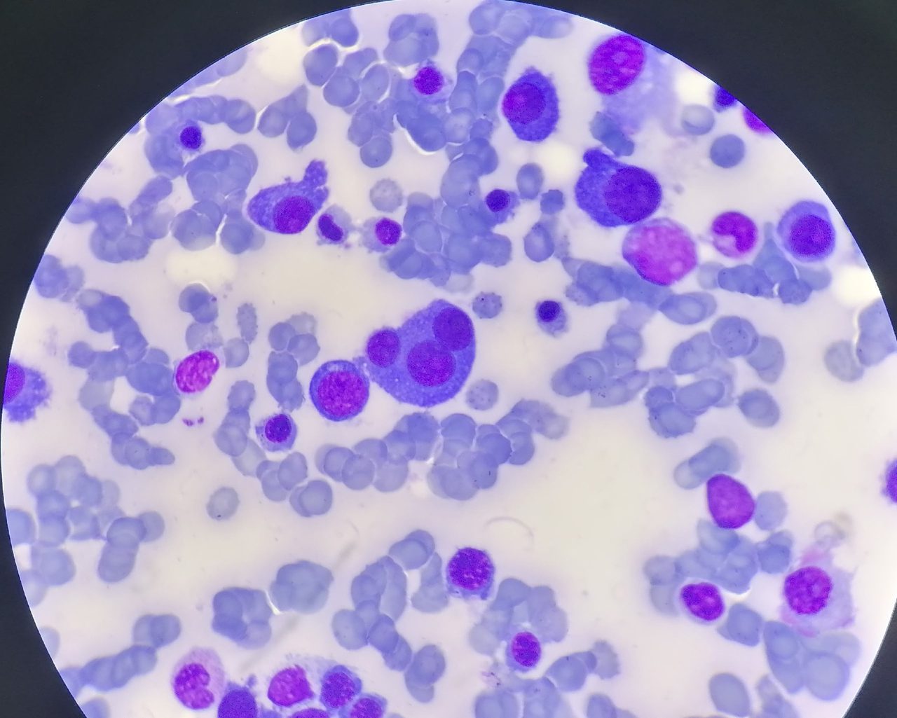 Multiple Myeloma: Plasma Cells in Bone Marrow