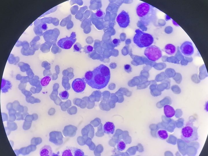 Bone marrow smear: trinucleated plasma cell in the center of the field of view