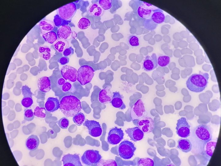 Bone marrow smear: pronounced plasma cell infiltration
