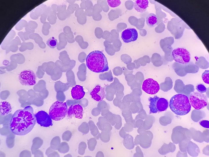 Bone marrow smear: atypical plasma cells and a mitotic figure on the left