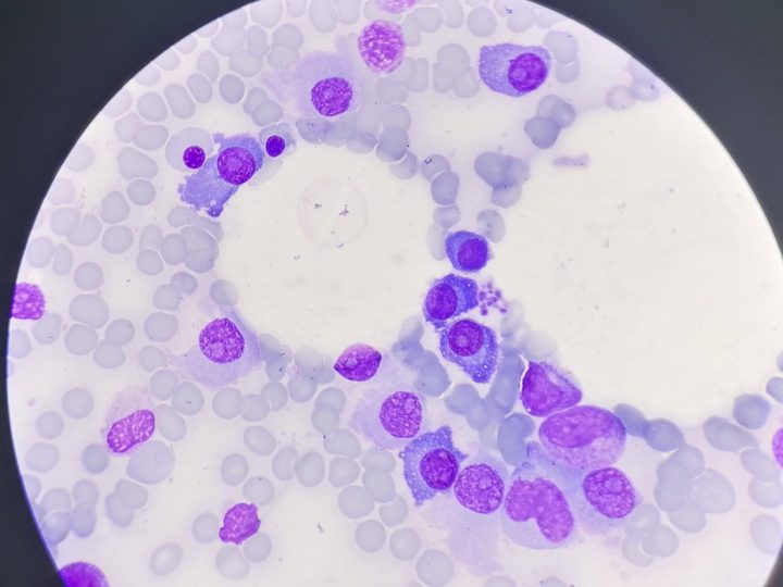 Bone marrow smear: binucleated plasma cell and perinuclear halo